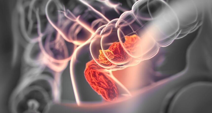 O que pode ajudar a prevenir câncer de intestino?