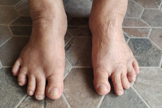Colesterol alto pode causar xantomas nos pés