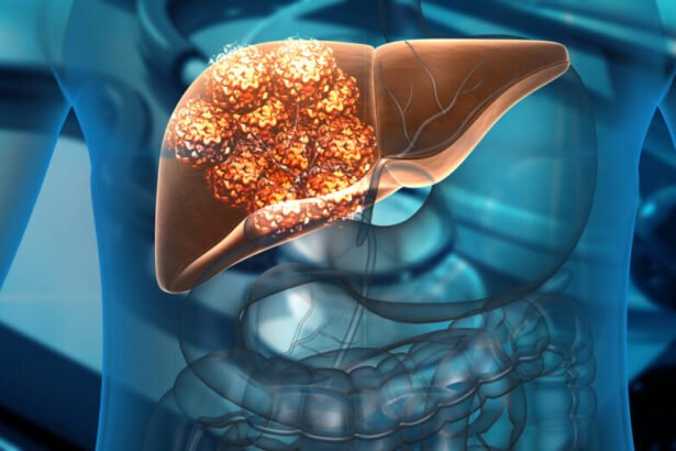 Conheça alguns dos sintomas de câncer de fígado