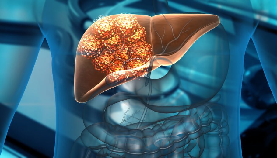 Conheça alguns dos sintomas de câncer de fígado