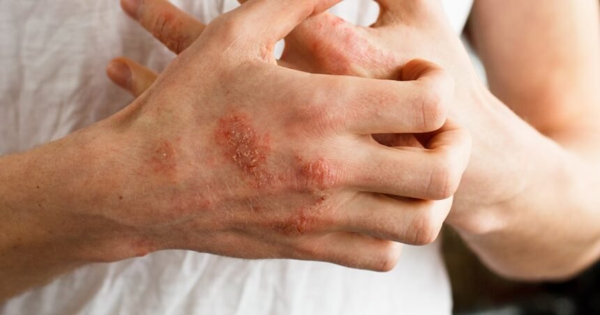 Afinal, o que é eczema? É a mesma coisa que dermatite atópica? Especialistas explicam